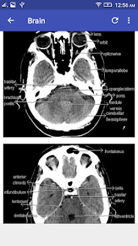 CT Scan Cross Sectional Anatomy for PC screenshot 1