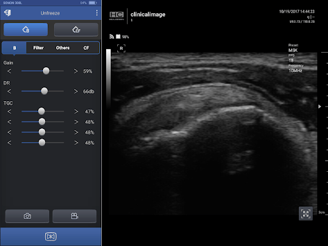 SONON Ultrasound App for PC screenshot 2