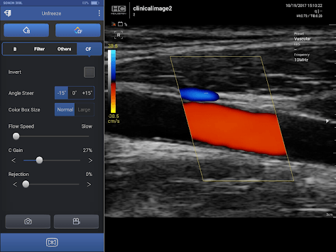 SONON Ultrasound App for PC screenshot 3